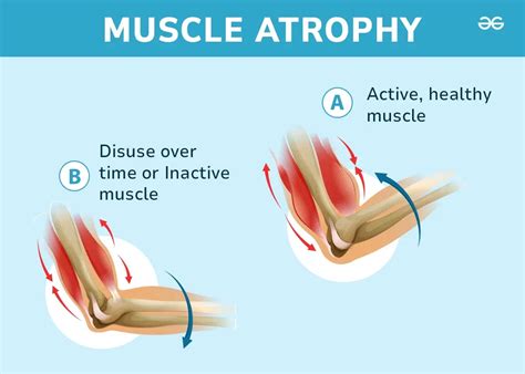 Atrophy Notes Types Causes And Symptoms Geeksforgeeks