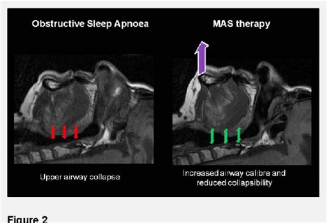 Figure 1 From Mandibular Advancement Splints For The Treatment Of Sleep