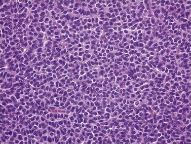 Ovarian Sex Cordstromal And Steroid Cell Tumors Basicmedical Key