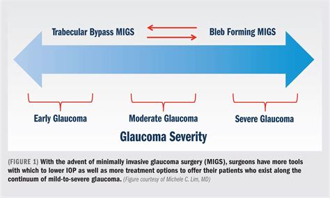 MIGS continues to innovate, secure place in glaucoma