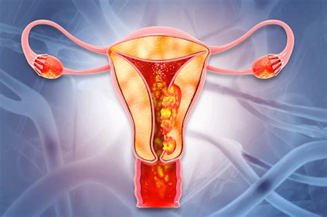 Female Reproductive System Diseases Uterus Cancer And Endometrial