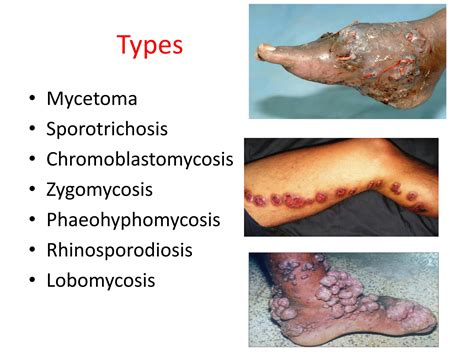 Solution Subcutaneous Mycosis Studypool