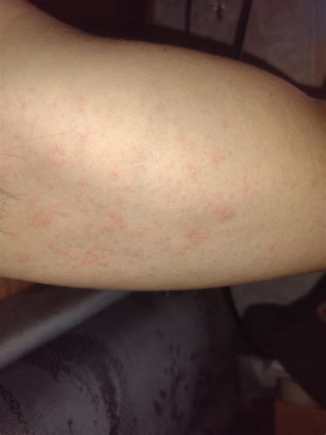 Scabies They Look Like Smaller Spots Than What Ive Seen Of Others