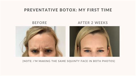 Preventative Botox Everything You Need To Know