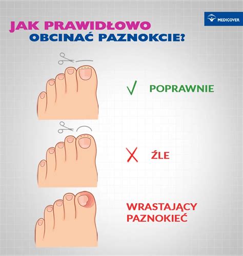 Wrastający paznokieć Domowe sposoby objawy leczenie