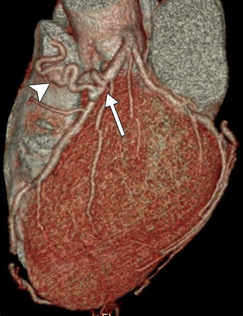 Coronary Artery Fistulas Pathophysiology Imaging Findings And