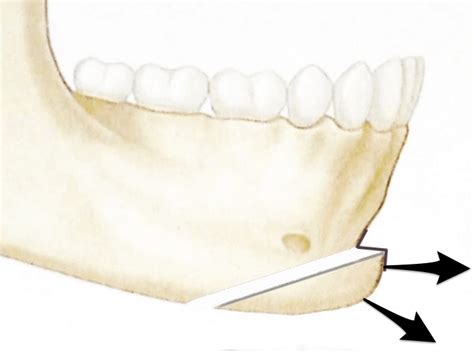 What Is A Sliding Genioplasty? - ArchWired