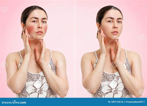 Portrait Of A Young Caucasian Woman Showing Redness And Inflamed Blood