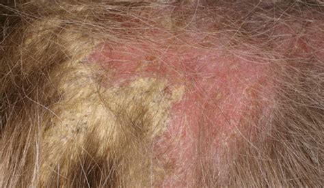 Seborrheic Dermatitis