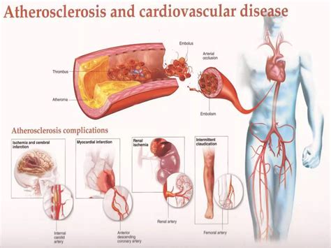 Atherosclerosis Pathophysiology PPT