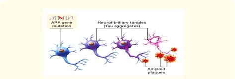 Representation Of How Neurofibrillary Tangles And Amyloid Plaques