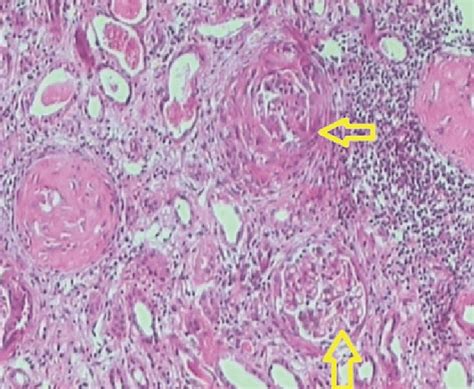 Section From Given Renal Biopsy Stained With H E Stain Shows