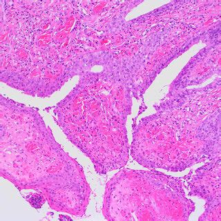 Histology Of The Specimen Surface Of Mesenchymal Hamartoma Covered