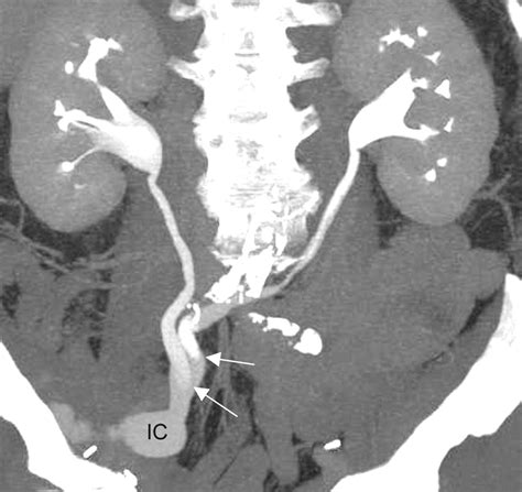 Ct Urography Of Urinary Diversions With Enhanced Ct Digital Radiography