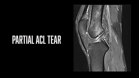 Partial Acl Tear Mri Knee Thereportingroom Youtube