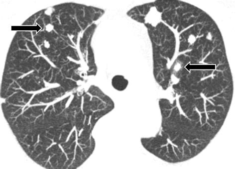 Amyloidosis Multisystem Spectrum Of Disease With Pathologic