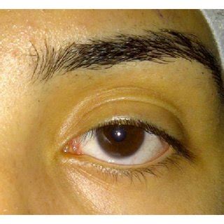 (a) Female patient aged 19, with lower eyelid retraction and increased... | Download Scientific ...