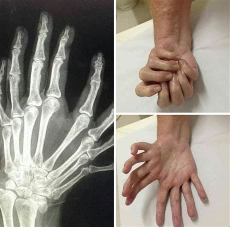 This Example Of Polydactyly R Mildlyinteresting Mildly Interesting