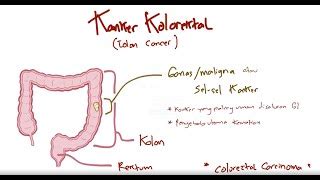 Penyakit Divertikulitis Spine Center