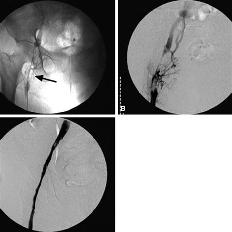 A Venogram Demonstrating A Filling Defect Obstructing The Left