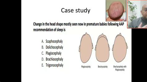 Case 59 AAP Recommendations of sleep in premature babies, abnormal head shapes - YouTube