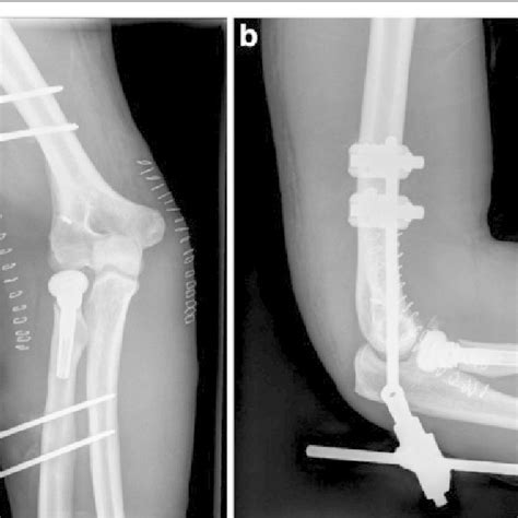 Postoperative Radiographs Anteroposterior A And Lateral B Views