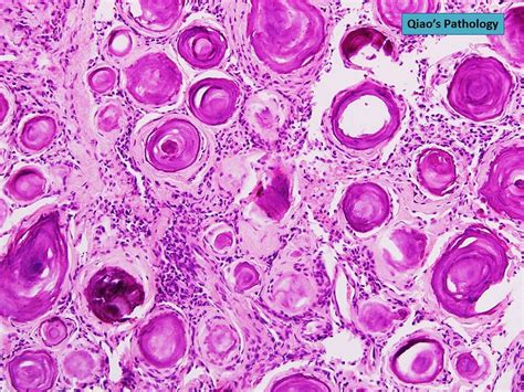 Qiao S Pathology Psammomatous Meningioma Microscopic Phot Flickr