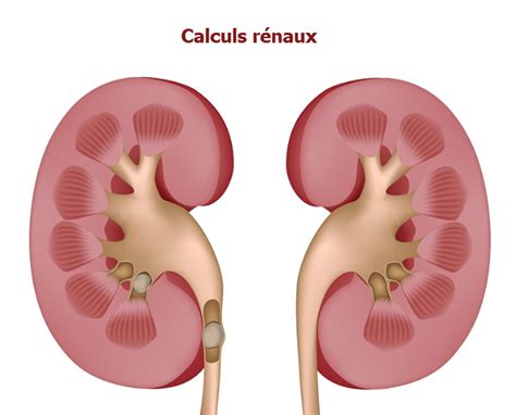 Pourquoi Fait Ont Des Calculs Rénaux