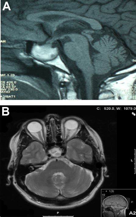 Mr Imaging Of Pituitary Apoplexy A A Sagittal T1 Image Of The