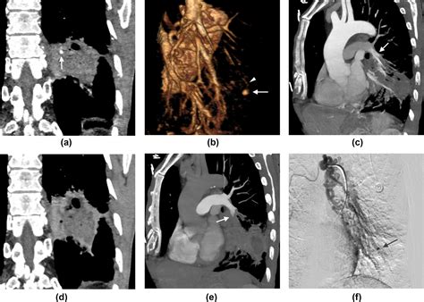 Bronchial Embolisation For Infected Pulmonary Artery Pseudoaneurysms Causing Haemoptysis