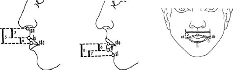 Figure 1 From Evaluation Of Upper And Lower Lip Growth Following Cronin