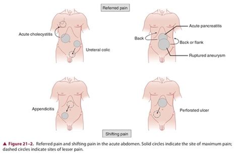 Acute Abdomen Flashcards Quizlet