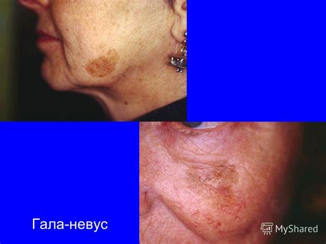 Презентация на тему: "Особенности течения меланомы на голове и шеи ...