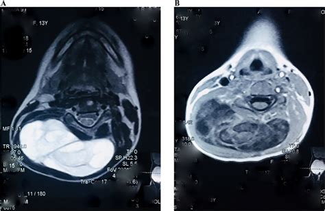 Mri Neck T1 And T2 Axial Images Show A Multilocular Cystic Lesion Download Scientific Diagram