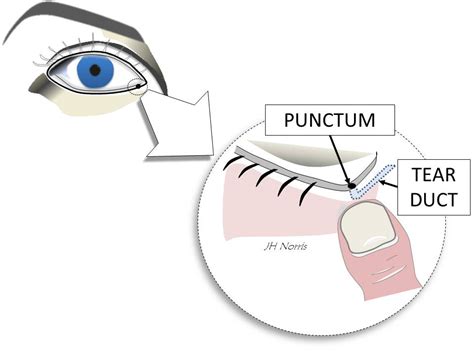 Punctoplasty Jonathan Norris