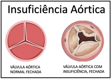 Insuficiência Aórtica Regurgitação Medicina de Excelência