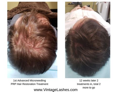 Advanced Hair Restoration A Guide To The Latest Technology All About