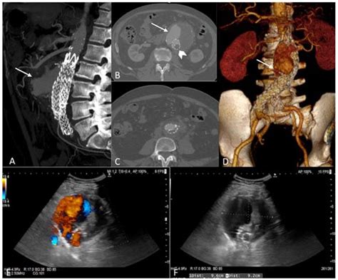 Preoperative Computed Tomography Angiography Cta Showing A D