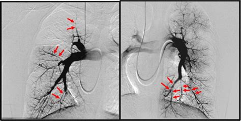 Pulmonary angiography. Angiography is a type of X-ray used to… | by ...