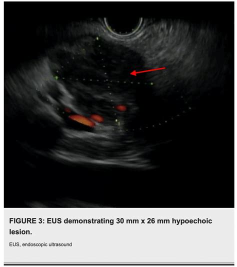 Eus Demonstrating 30 Mm X 26 Mm Hypoechoic Lesion Download Scientific Diagram