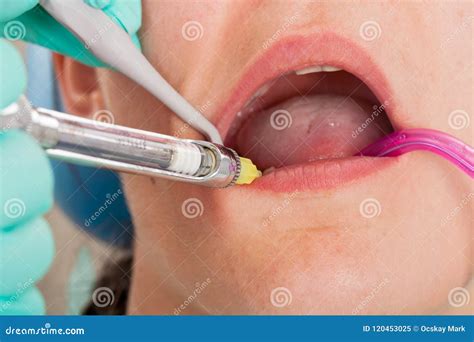 Dental Anesthesia Stock Image Image Of Medical Female 120453025