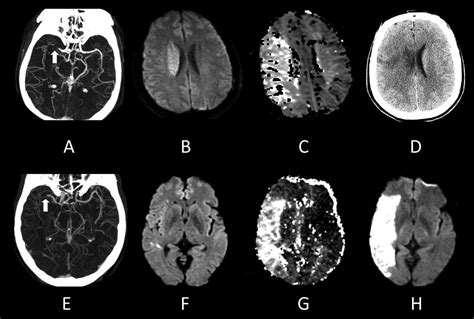 Clinical Mri Of Acute Ischemic Stroke González 2012 Journal Of Magnetic Resonance Imaging