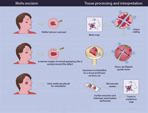 Mohs Micrographic Surgery Pictures Photos