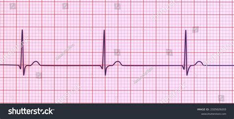 Slow Junctional Rhythm