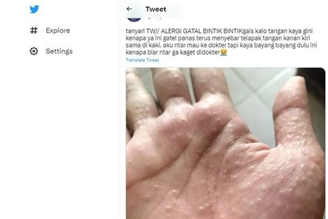 Foto Ramai Soal Bintik Bintik Di Telapak Tangan Yang Terasa Gatal Dan