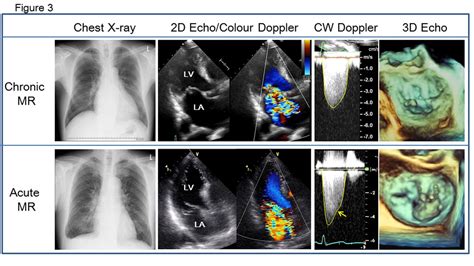 Acute Mitral Regurgitation Heart