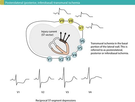 ST elevation myocardial infarction (STEMI) without ST elevations on 12 ...