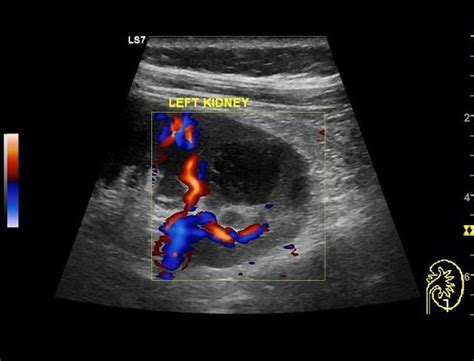 The main complication is abscess rupture. When it does into the calyceal system then it's called ...