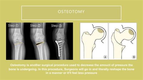 Osteonecrosis Ppt