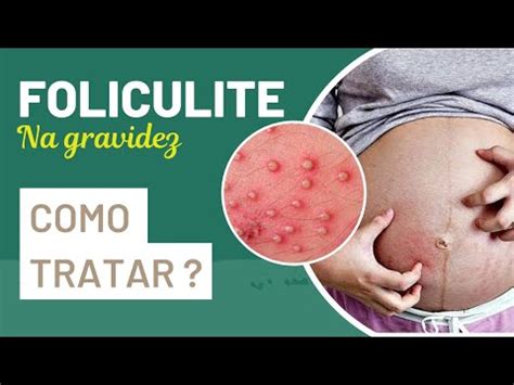 Foliculite Na Gravidez Saiba Como Tratar Foliculite Pruriginosa